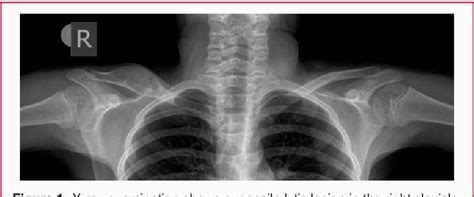 Figure 1 From Aneurysmal Bone Cyst In The Clavicle Resembling A