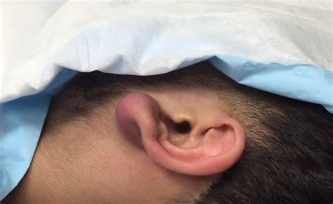 How To Drain An Infected Earlobe Best Drain Photos Primagemorg