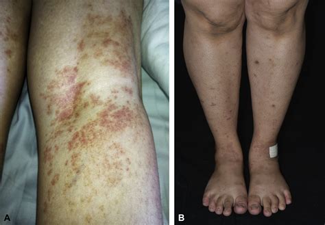 Sinovac Covid 19 Vaccineinduced Cutaneous Leukocytoclastic Vasculitis