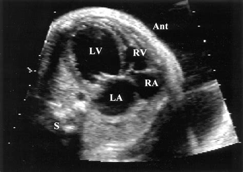 Premature Closure Of The Foramen Ovale And Ductus Arteriosus In A Fetus With Transposition Of