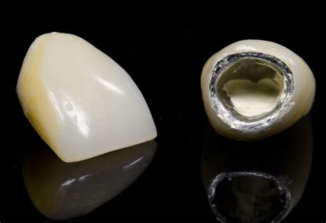 ¿zirconio O Metal En Coronas Sobre Implantes Estudi Dental Barcelona