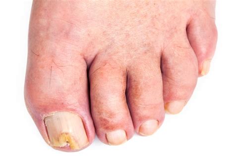 Fungal infections that appear on the skin are one of the most common infections in humans. Toenail Fungus - Pictures, Symptoms, Causes, Treatment