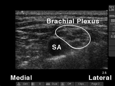 Figure From Ultrasound Guided Supraclavicular Brachial Plexus Nerve