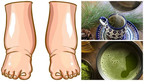 This Powerful Home Made Tea Will Cure Swollen Legs In Few Days