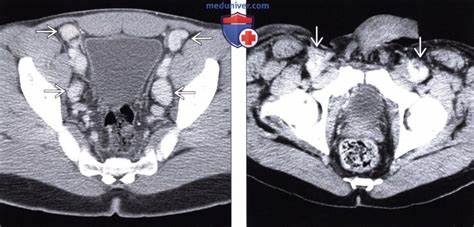 Рентгенограмма, КТ, УЗИ брюшной полости при саркоме Капоши Картинка - Рентгенограмма, КТ, УЗИ брюшной полости при саркоме Капоши