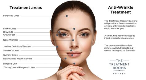 Botox Anti Wrinkle Injections London Book A Free Consultation
