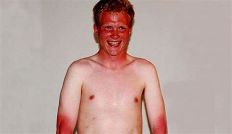 Oc Man Suffers Incredibly Severe Sunburn After Waiting Hours For Last Wave In The Inertia