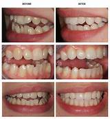 Photos of Lower Teeth Crowding Treatment