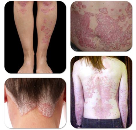 How To Get Rid Of Psoriasis Psoriasis Treatment Psoriasis Skin Care