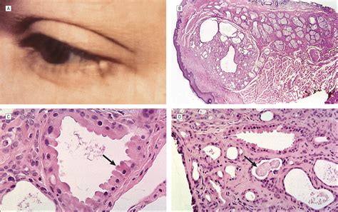 Moll Gland Neoplasms Of The Eyelid A Clinical And Pathological