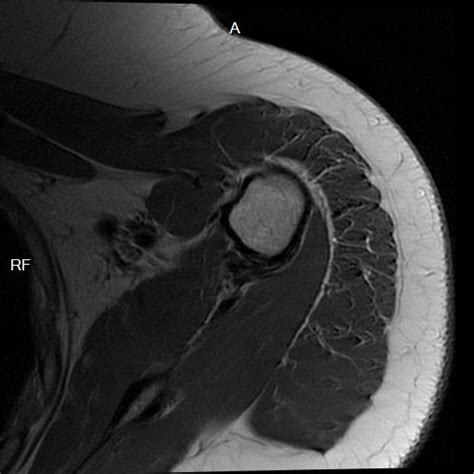 Axial Shoulder T1 3 Radiology Library