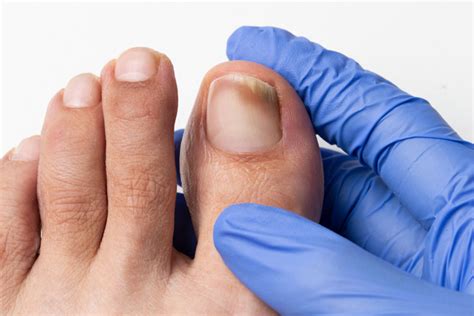 Toenail Fungus Treatment What Are My Options — Foot And Ankle Centers