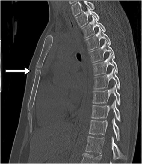 Pediatric Sternal Fractures From A Level 1 Trauma Center Journal Of