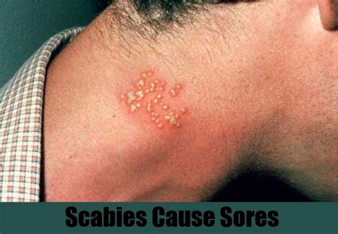 4 Most Common Scabies Symptoms Natural Home Remedies And Supplements