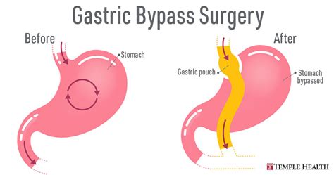 Intussusception After Laparoscopic Roux En Y Gastric Bypass Surgery
