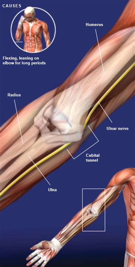 Cubital Tunnel Syndrome Central Coast Orthopedic Medical