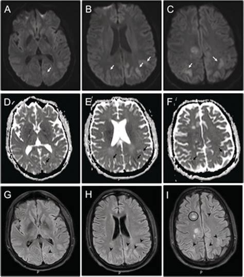 Chapter 10 Hypoxicischemic Brain Injury After Cardiac Arrest