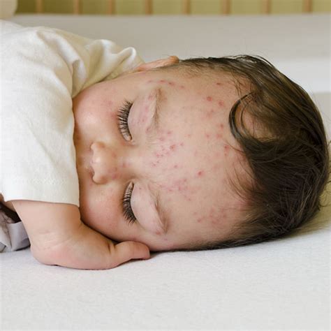 Hal ini sering terjadi pada bayi, namun dapat terjadi pada semua usia. Gejala 4 Penyakit Ini Ruam dan Demam. Bagaimana Membedakannya?