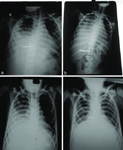 Chest X Ray During The Entire Perioperative Period A Cxr Showing