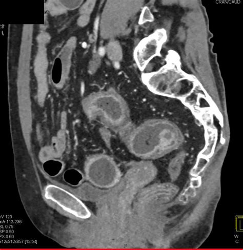 Ulcerative Colitis With Stricture Best Seen In Rectum With Inflammatory