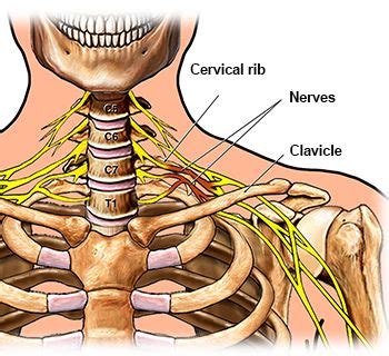 Pin on Cervical Rib