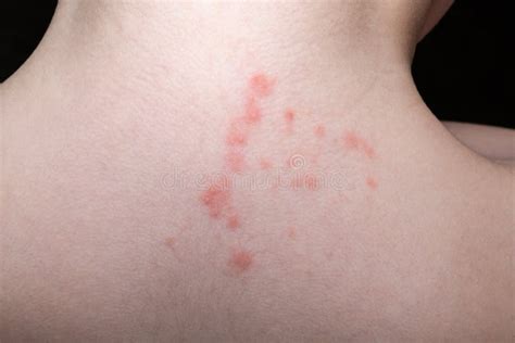 Baby Skin Rash And Allergy With Red Spot Cause Stock Photo Image Of