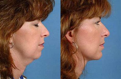 Neck Procedures Before And After Photos Patient 113 Louisville Ky