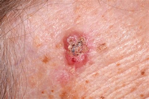 Basal Cell Carcinoma Skin Cancer Stock Image C0370912 Science