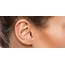 Ear Surgery  Otoplasty Cosmetic Plastic Newcastle