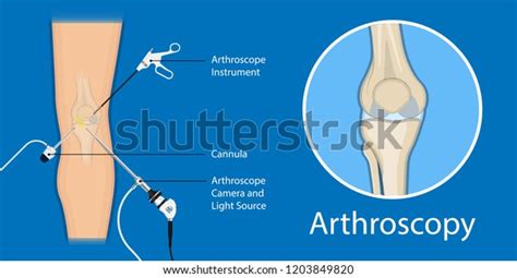 Arthroscopy Medical Treatment Surgery Keyhole Surgical Stock Vector