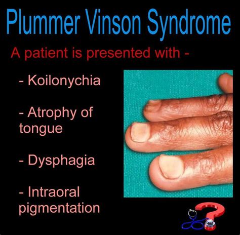 Plummer Vinson Syndrome Medizzy