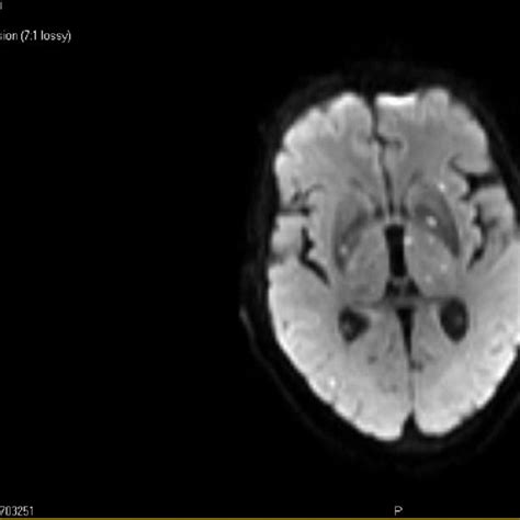 Axial View Of Mri Brain Showing Multiple Small Embolic Infarcts Dwi