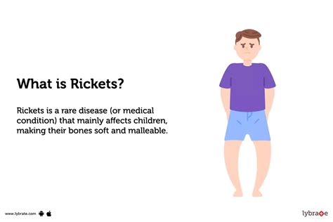 Rickets Causes Symptoms Diagnosis And Treatments
