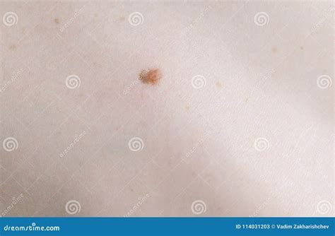 Woman`s White Skin With Moles View Top Close Up Back Stock Image