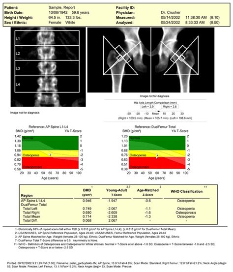 Abnormal bone density test results. Men: Watch Your Bones! - Healthy Merlin