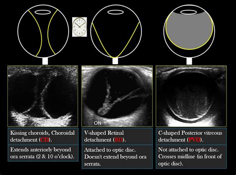 Types Of Ocular Detachments Human Skeletal System Diagnostic Medical