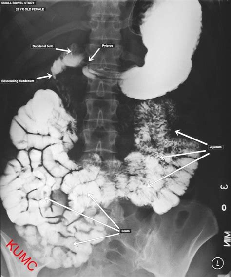 Small Bowel Series From Ku Radiographic Anatomy Radiology Radiology