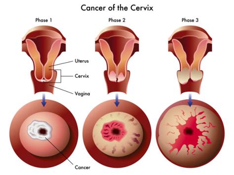 The following procedures may be used to diagnose cervical cancer Don't Wait for Symptoms of Cervical Cancer to Appear ...
