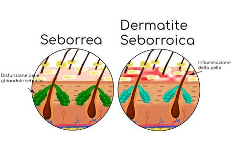 Dermatite Seborroica Sintomi Cause E Rimedi Malattie