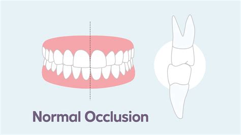 Malocclusion Treatments Types And Consequences