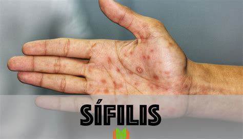 Sífilis O Que é Sintomas Diagnóstico Tratamento Prevenção