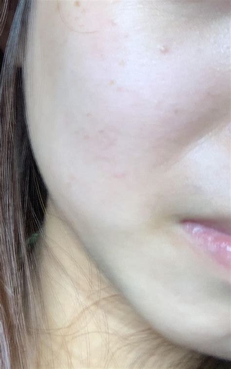 White Bump Thing Has Been On My Face For Months What Shld I Do To