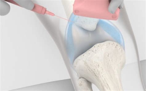 New Hydrogel Injection For Knee Osteoarthritis Offers Patients A Return