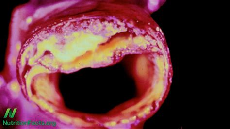 Brain aneurysms are more common in adults than in children and more common in women than in men. How to help prevent abdominal aortic aneurysms - YouTube