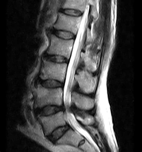 Lumbar Spinal Stenosis Spine Orthobullets 9922 Hot Sex Picture