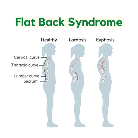 Flat Back Syndrome Orchard Health Clinic Osteopathy Physiotherapy