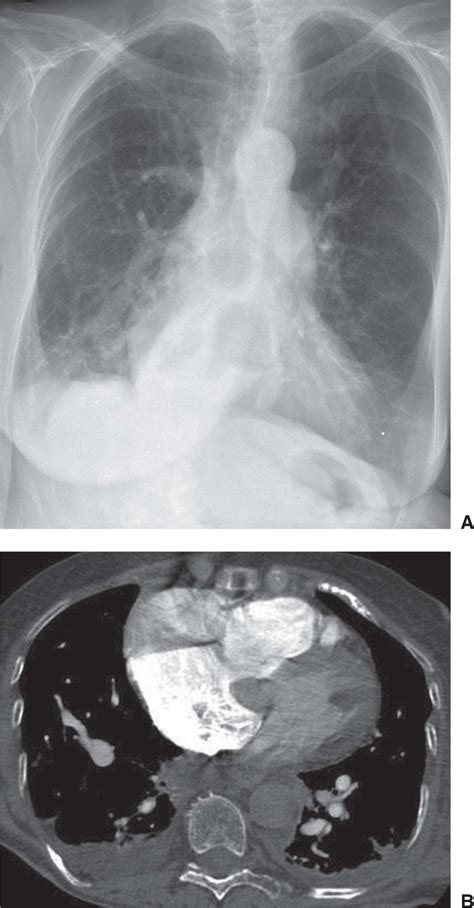 Solitary And Multiple Pulmonary Nodules Radiology Key