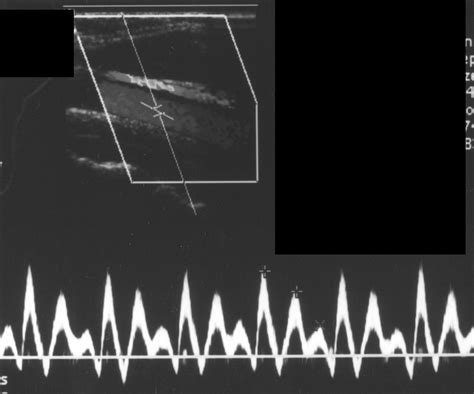 A Spectrum Of Doppler Waveforms In The Carotid And Vertebral Arteries Ajr