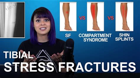 Tibial Stress Fractures Cause Treatment Comparisons Youtube