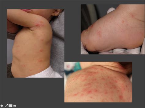 Common Pediatric Skin Diseases Flashcards Quizlet